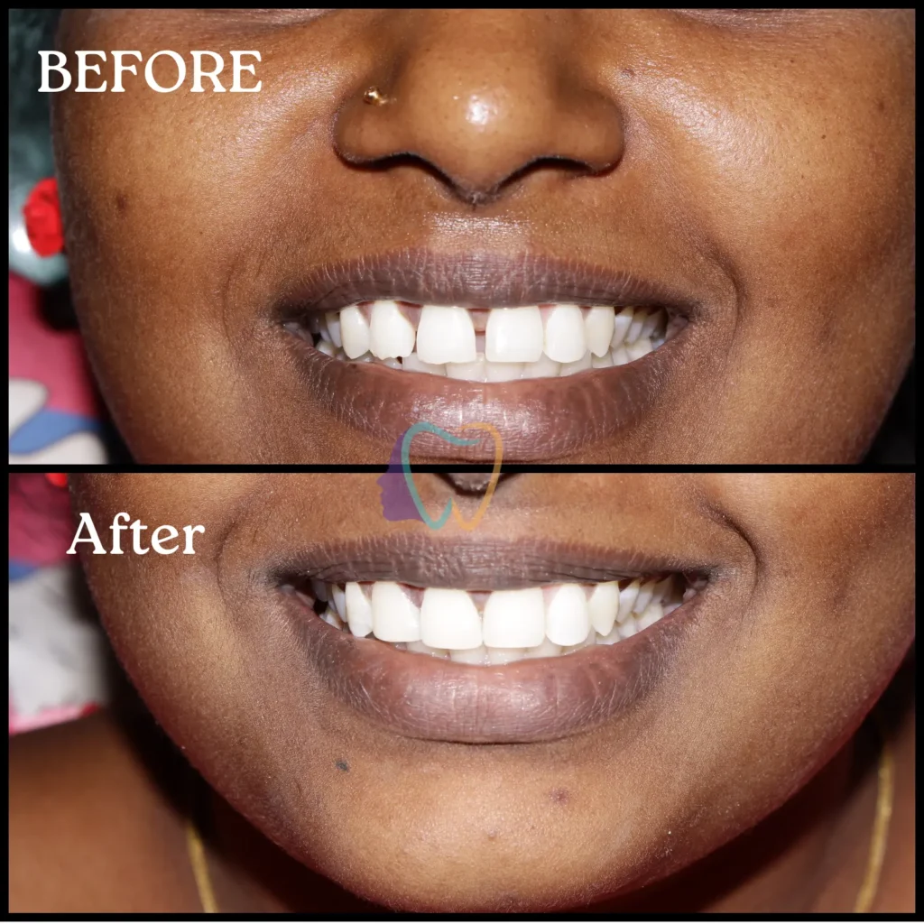 Cosmetic dental gap closure results