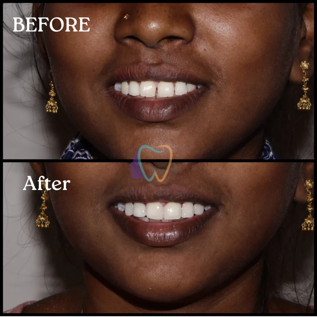 Before after dental gap treatment