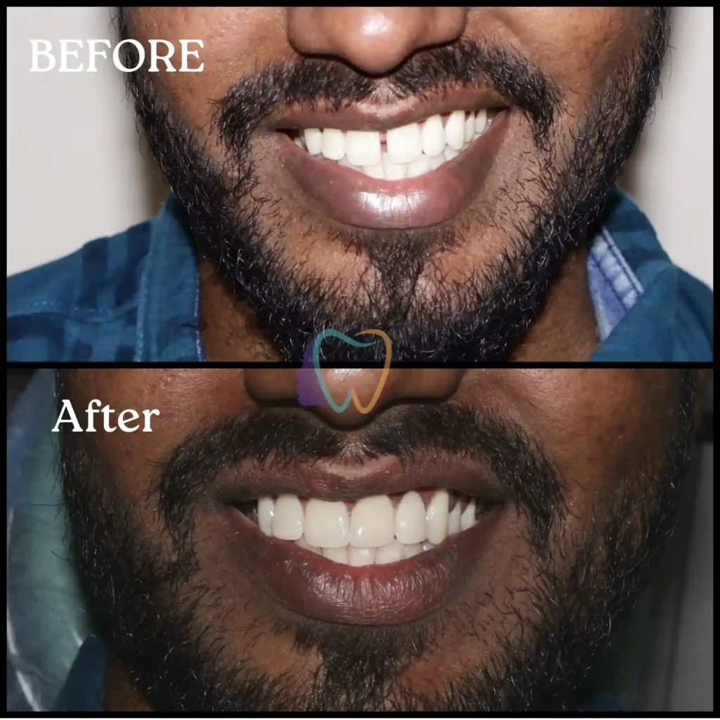 Smile transformation after gap closure