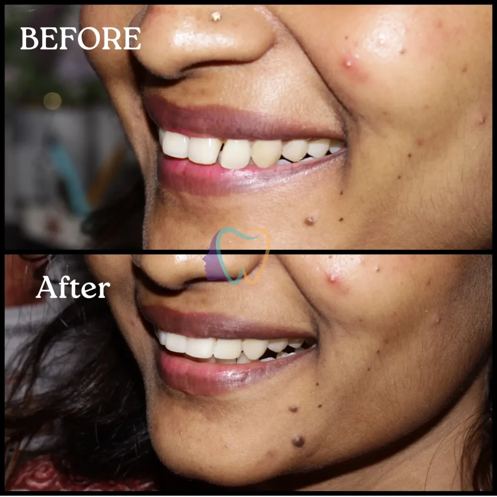 Successful teeth gap correction smile