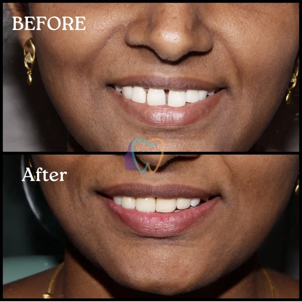 Smile makeover using teeth gap closure