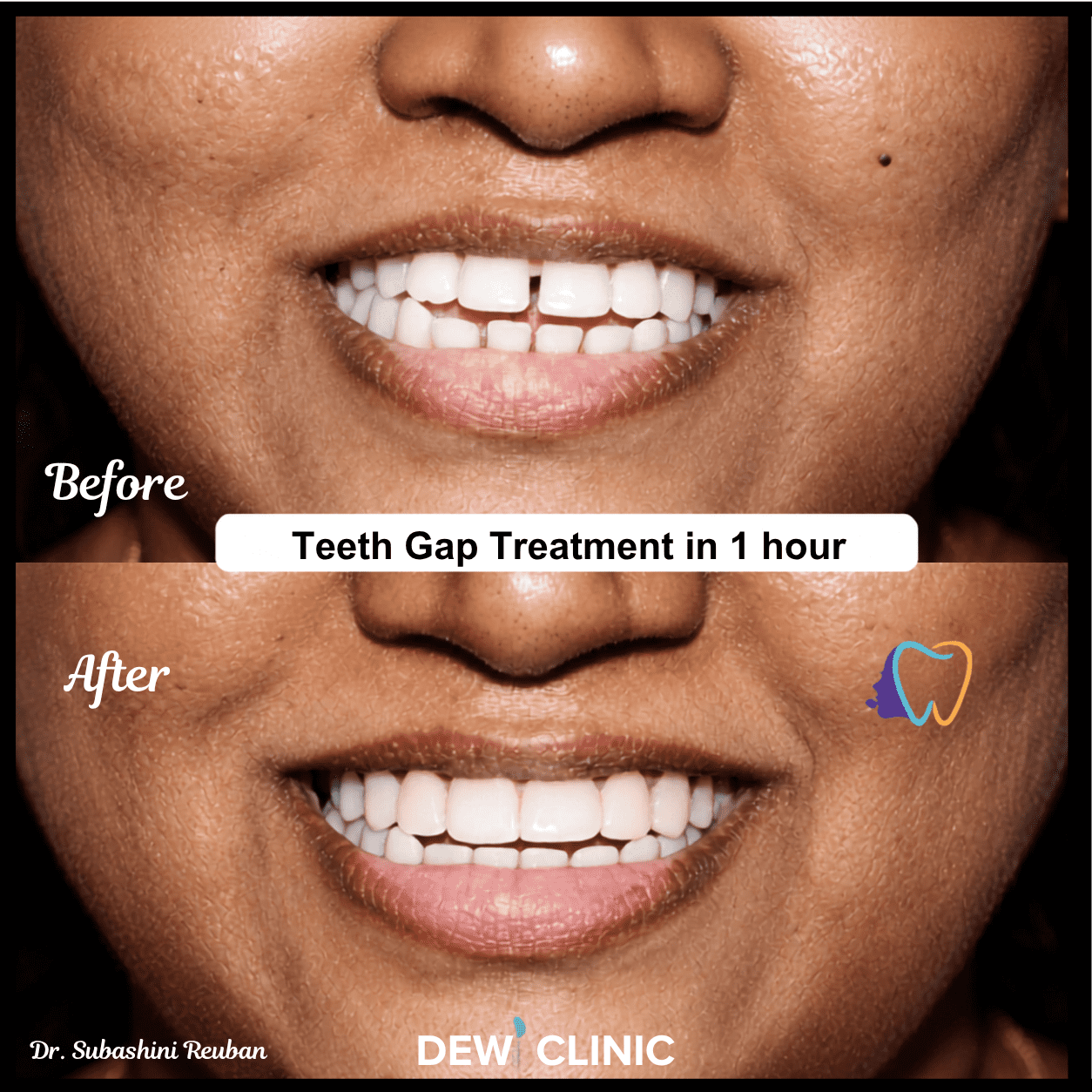 Advanced smile design treatment correcting front teeth gaps
