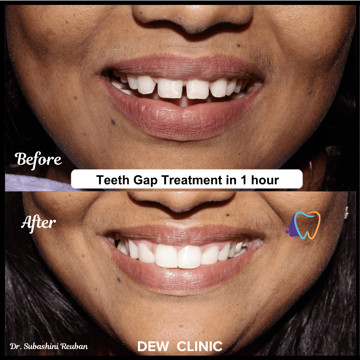 Teeth spacing correction before and after at Dew Clinic Chennai
