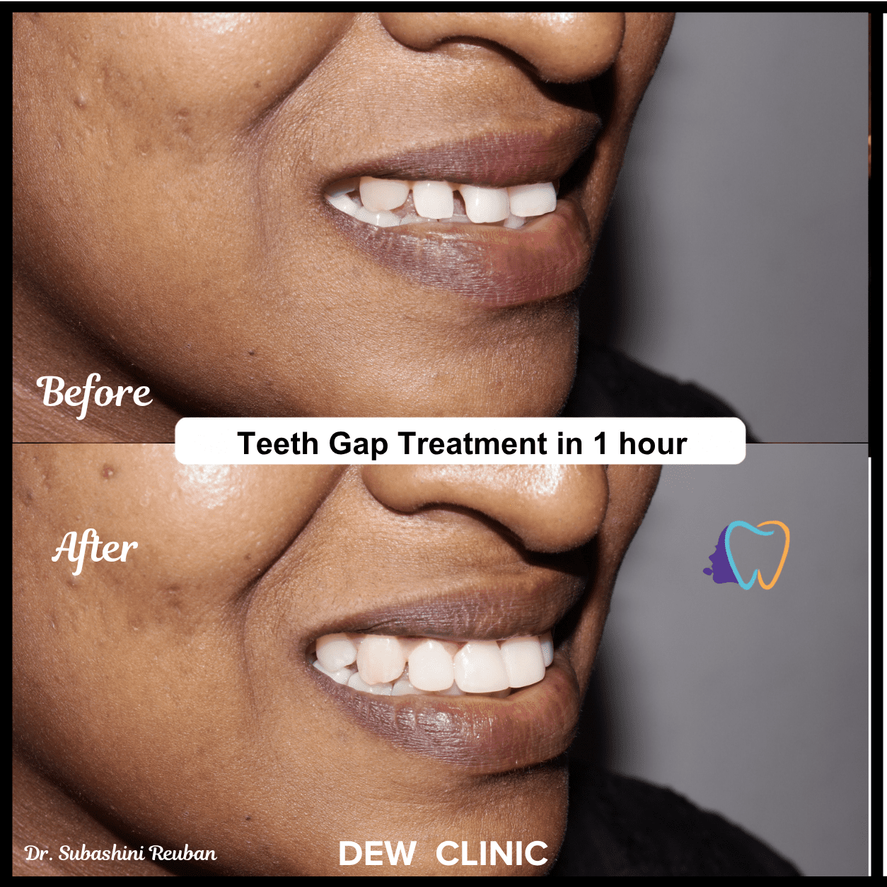Diastema closure treatment results showing reduced teeth spacing