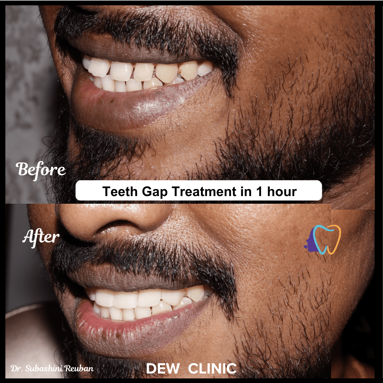 Patient smile after best teeth gap treatment in Chenna
