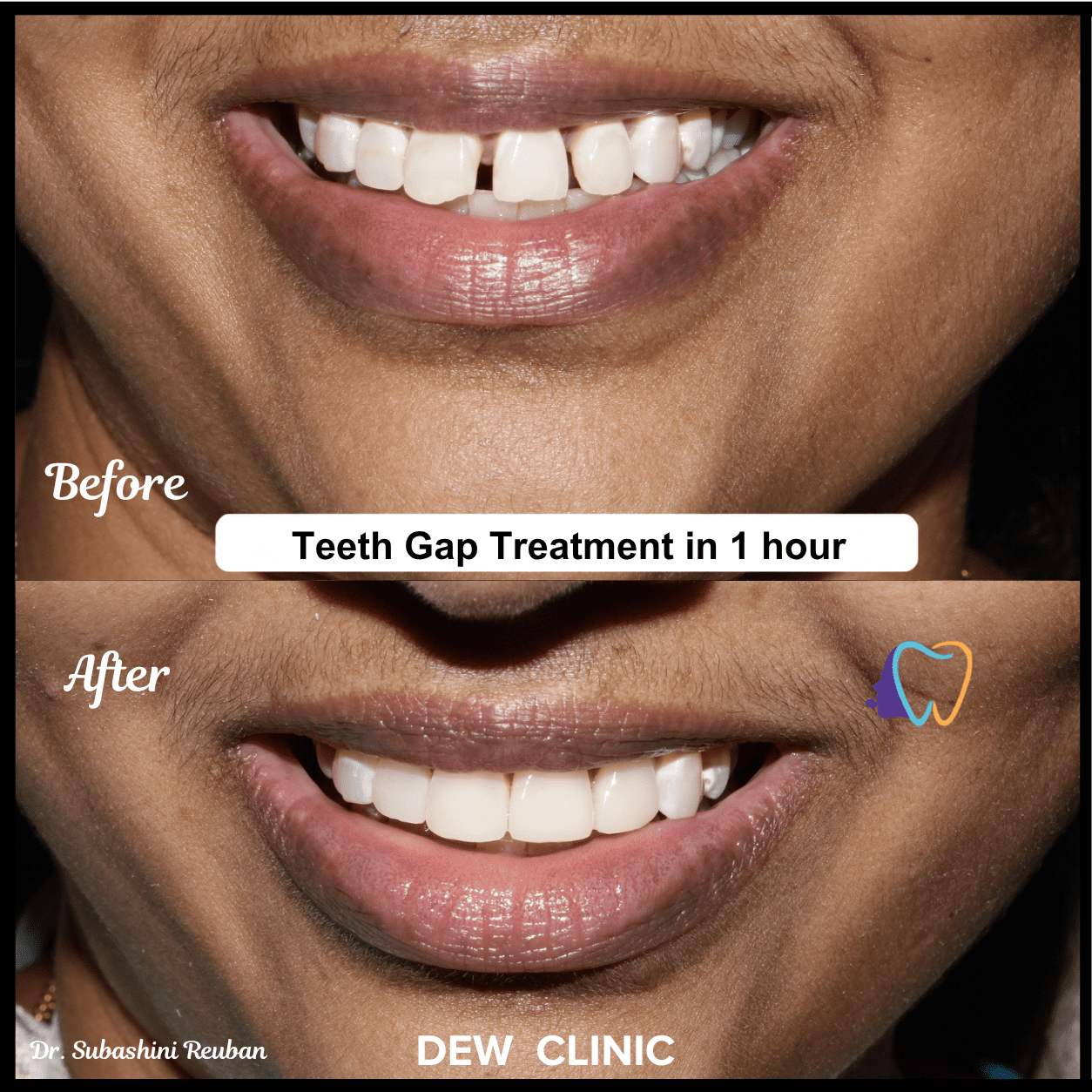 Teeth gap correction procedure improving smile aesthetics