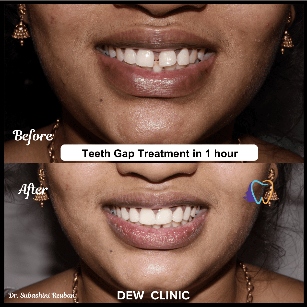 Before and after dental gap filling treatment at Chennai dental clinic
