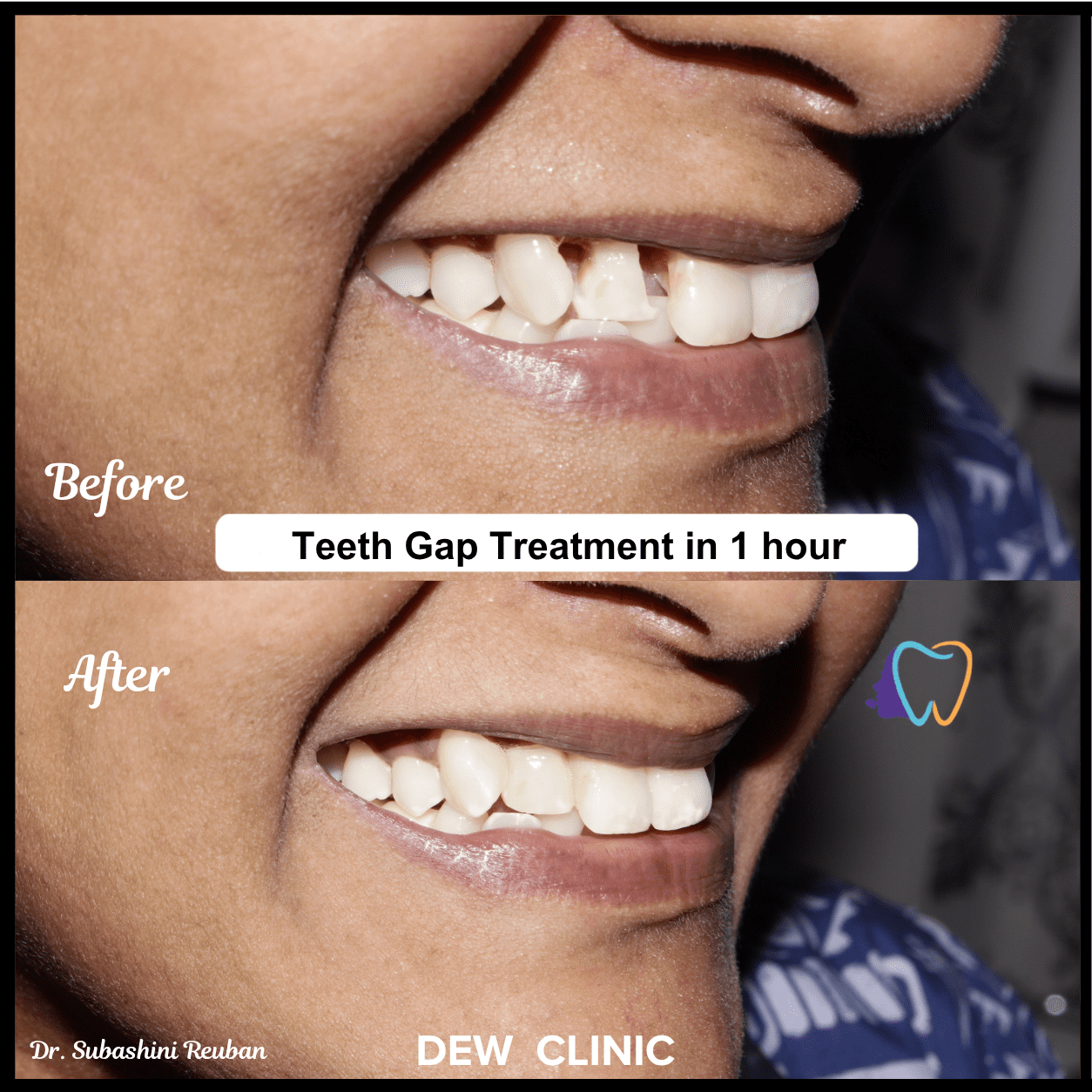 Smile makeover results after professional teeth gap treatment