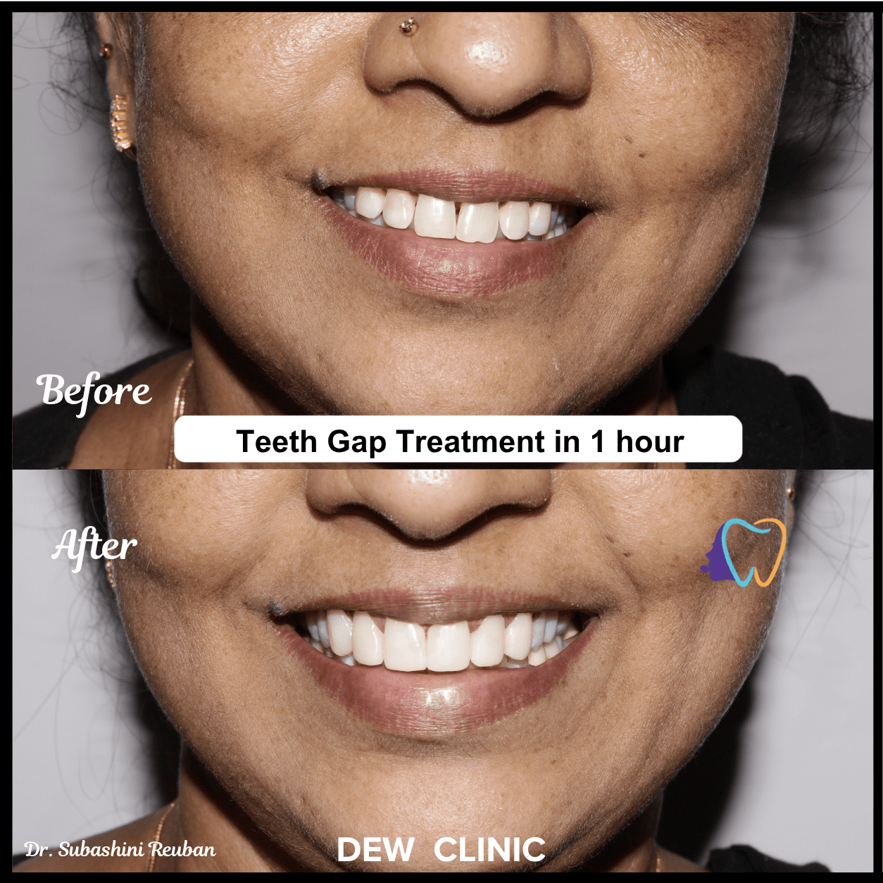 Cosmetic dentistry treatment for correcting gap between front teeth