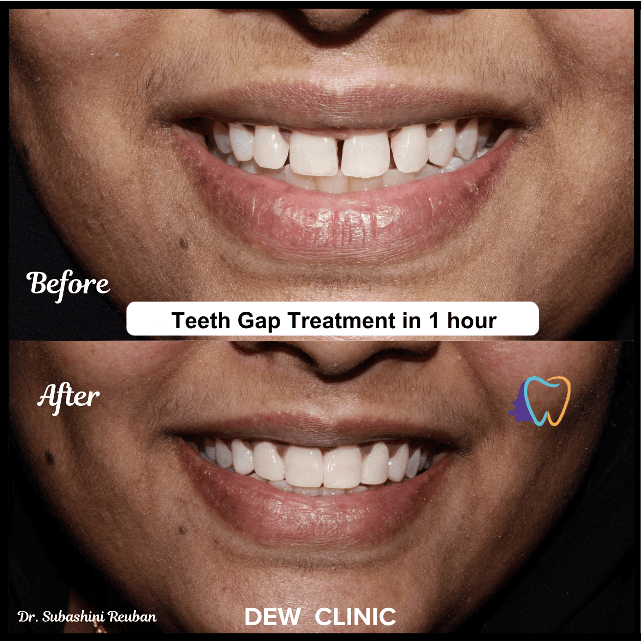 Teeth Gap Treatment at Dew Clinic Chennai