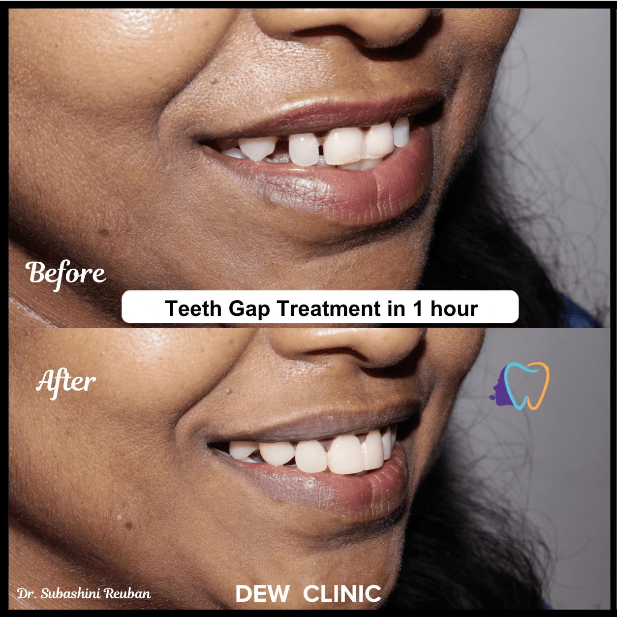 Cosmetic dental bonding treatment used for teeth gap closure