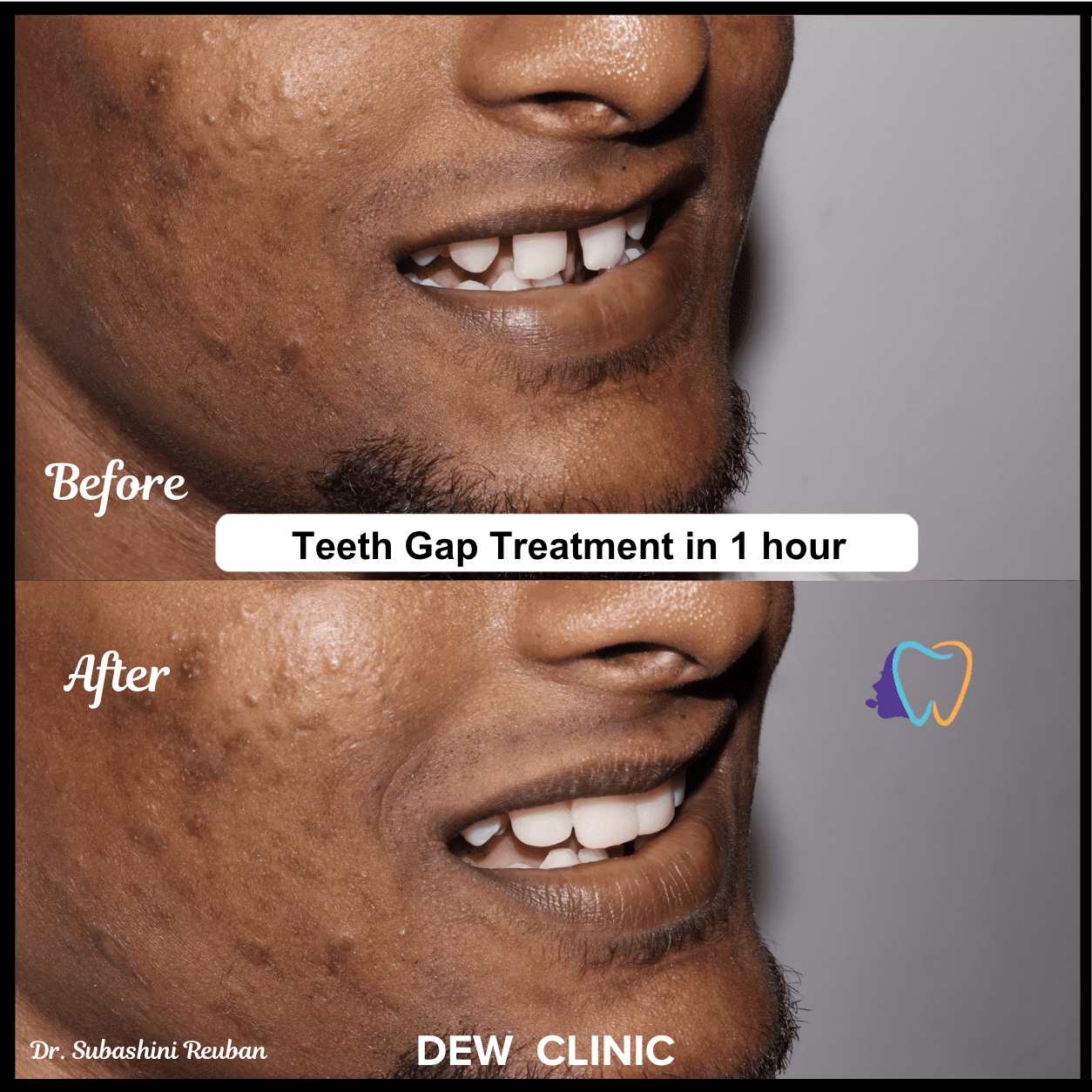 Front teeth gap closure treatment showing smile transformation in Chennai