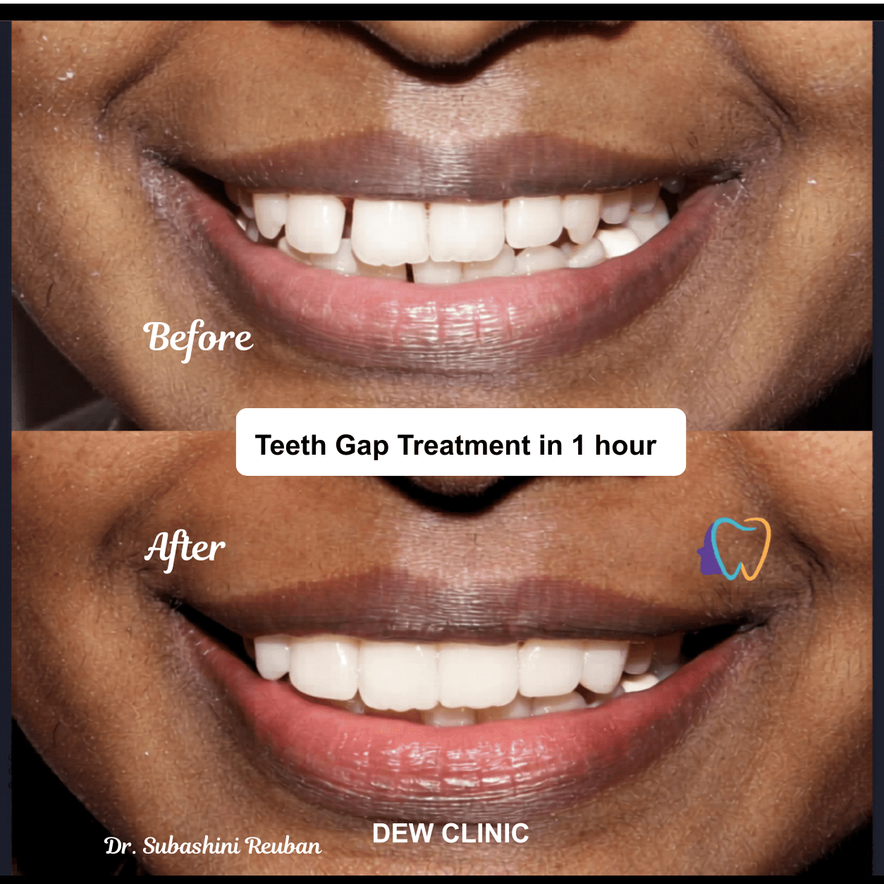Teeth gap treatment Chennai before and after smile correction results