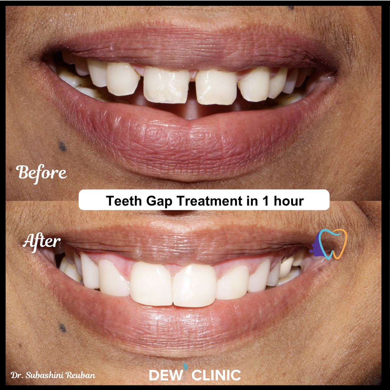 Before and after smile transformation using cosmetic teeth gap treatment