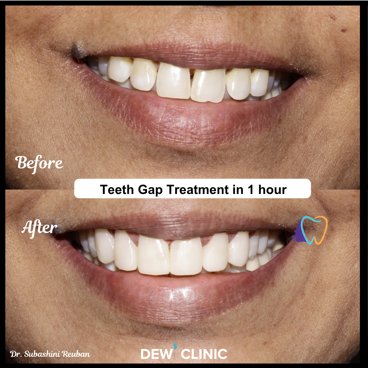Advanced cosmetic dental treatment showing teeth gap closure before and after results