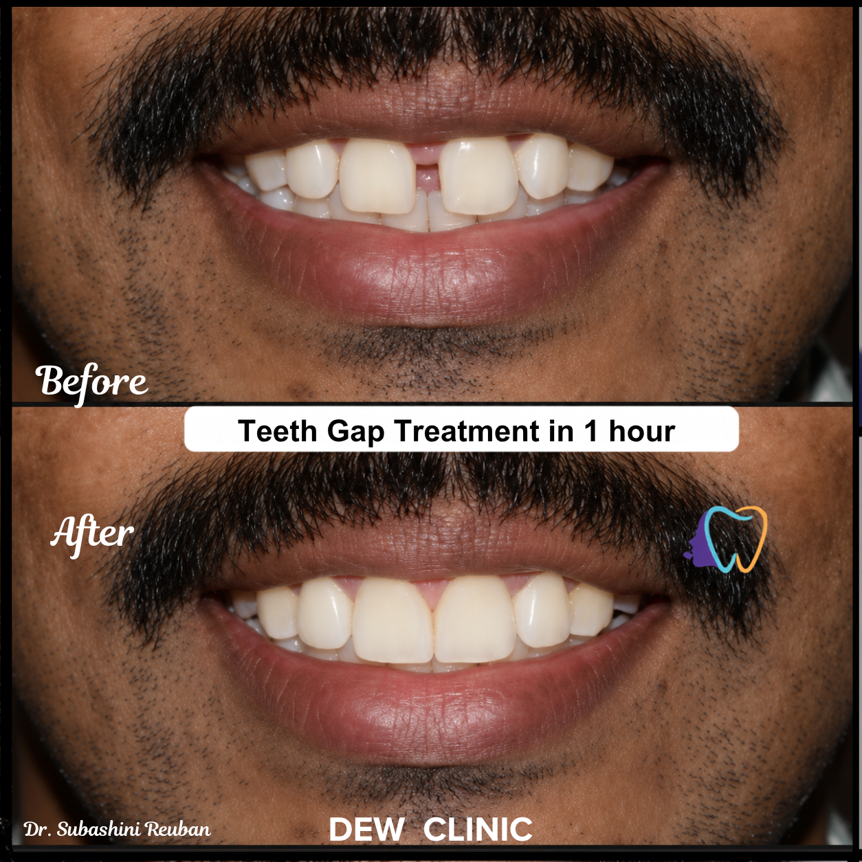Before After Teeth Gap Closing Treatment
