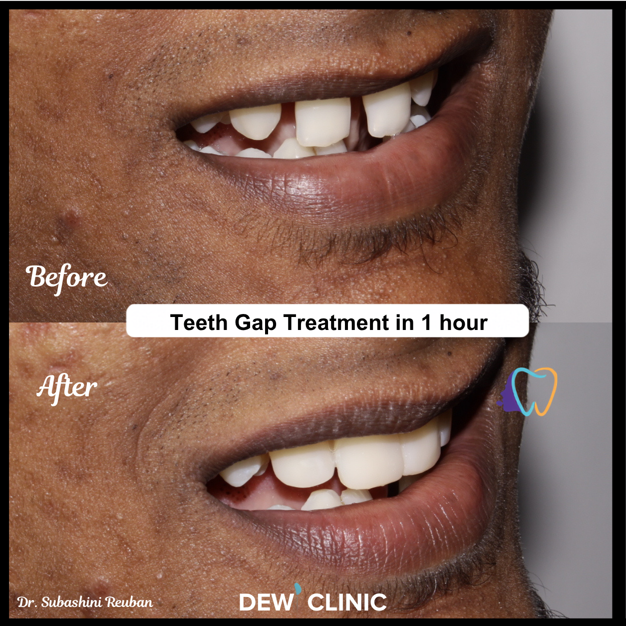 Best Cosmetic Dentist for Teeth Gap Chennai