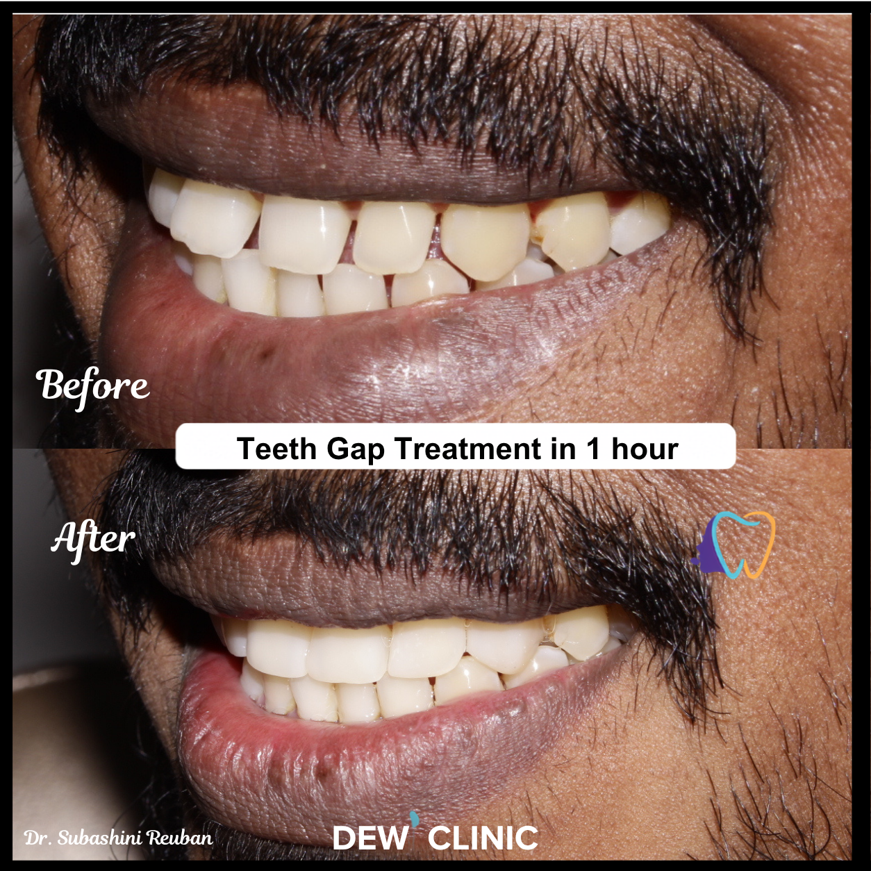 Best Teeth Gap Closure Treatment in Chennai
