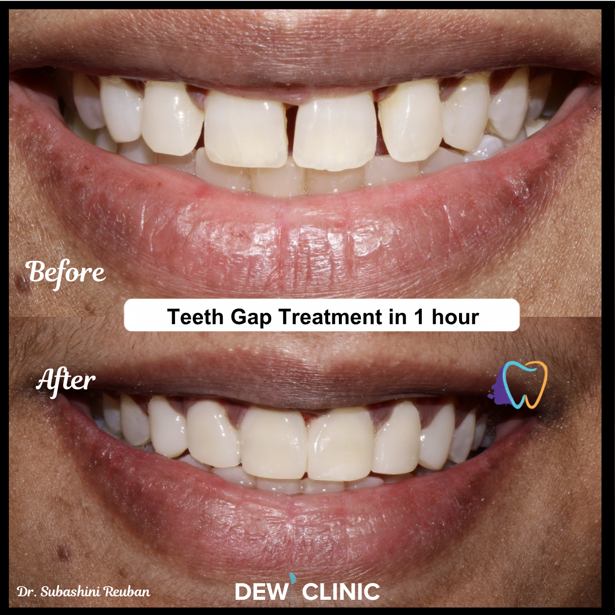 Composite bonding before and after for front teeth gap correction in Chennai