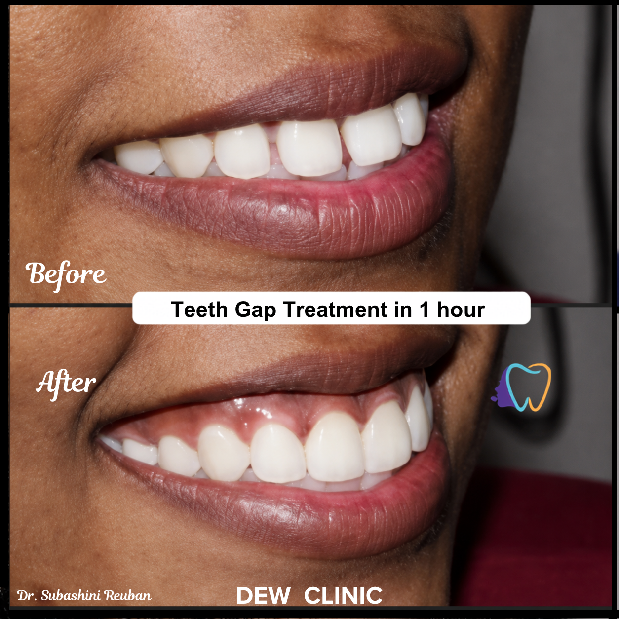 Cosmetic Dentistry Teeth Gap Results