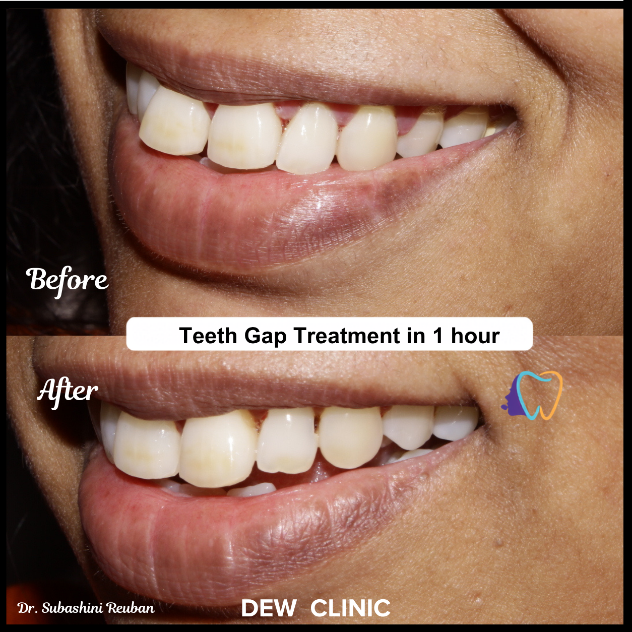 Patient smile before and after professional teeth gap closure treatment