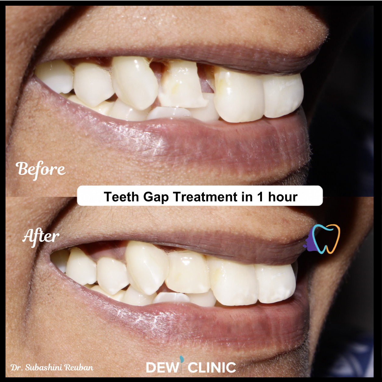 Cosmetic Teeth Gap Filling Treatment Chennai