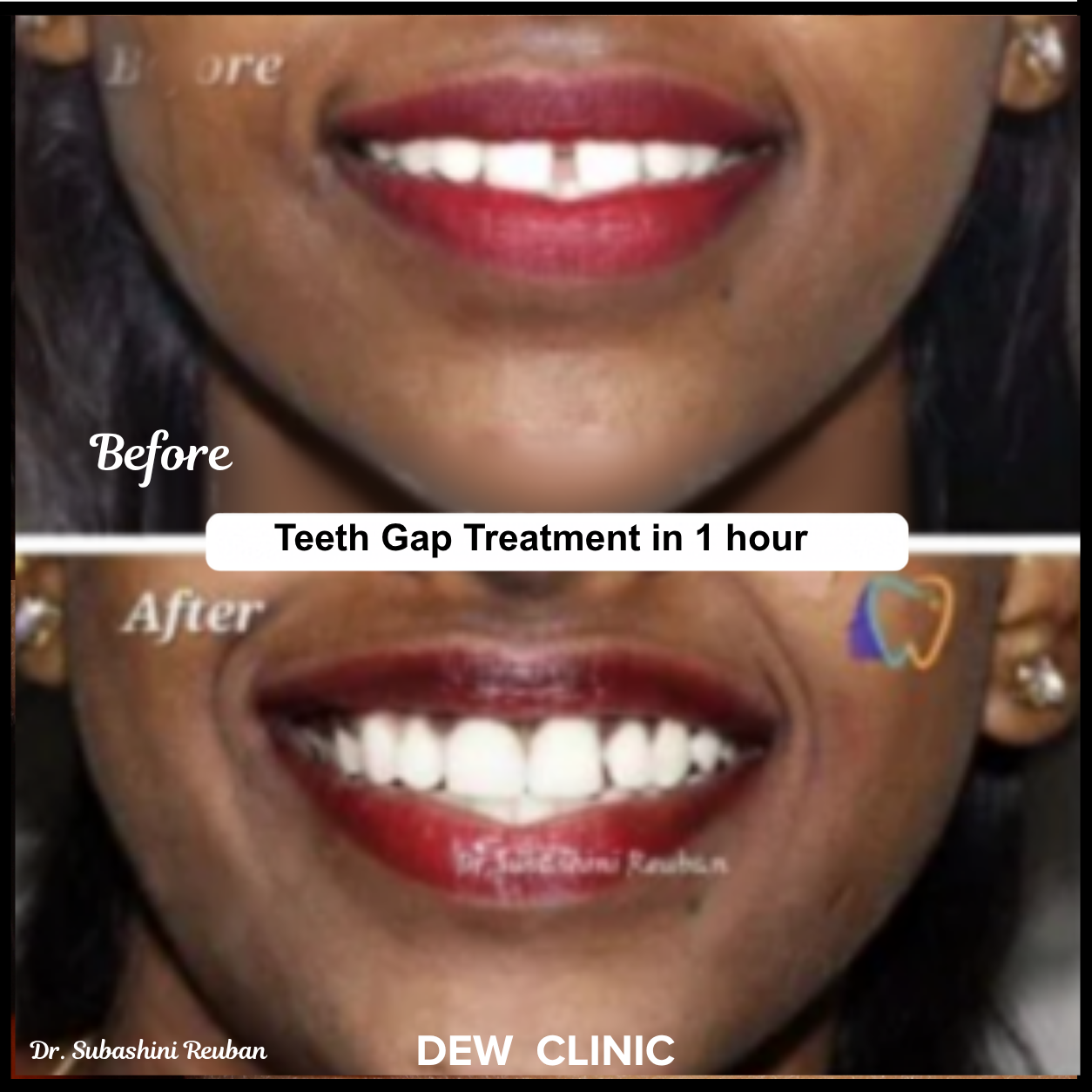 Dental Bonding for Teeth Gap Chennai