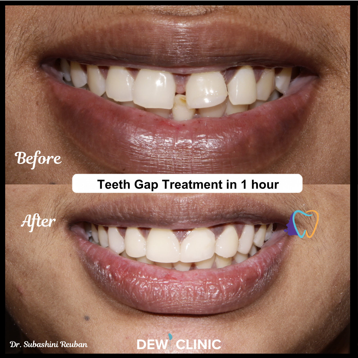 Smile enhancement with teeth gap filling treatment before and after results