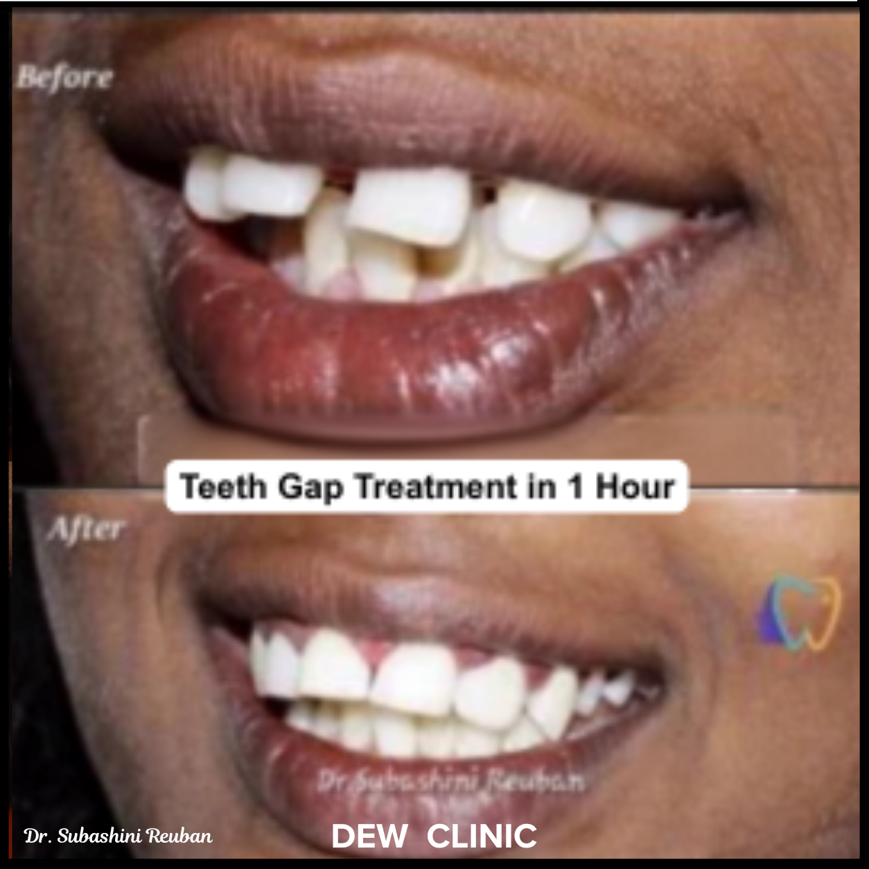 Instant Teeth Gap Closure Treatment