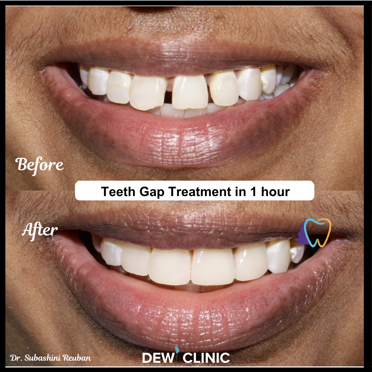 Before and after cosmetic dental treatment for natural teeth gap closure