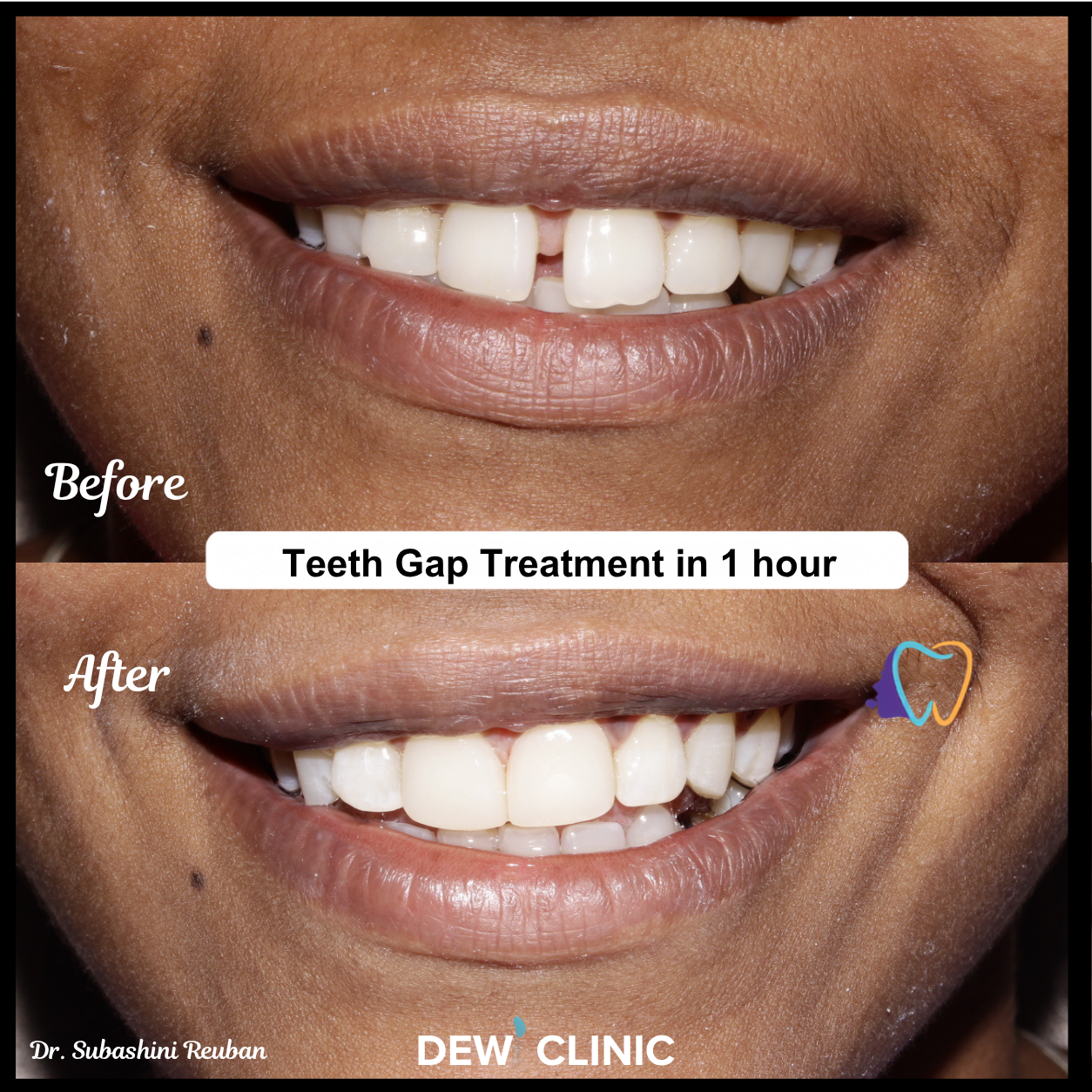 Natural Looking Teeth Gap Closure Chennai