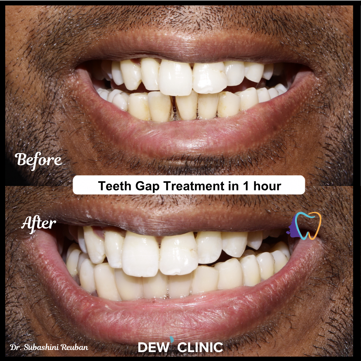Painless Teeth Gap Treatment at Dew Clinic
