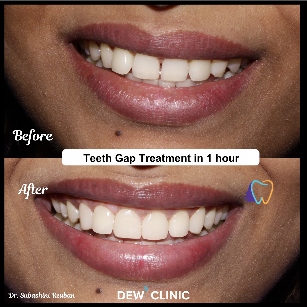 Professional Teeth Gap Smile Correction