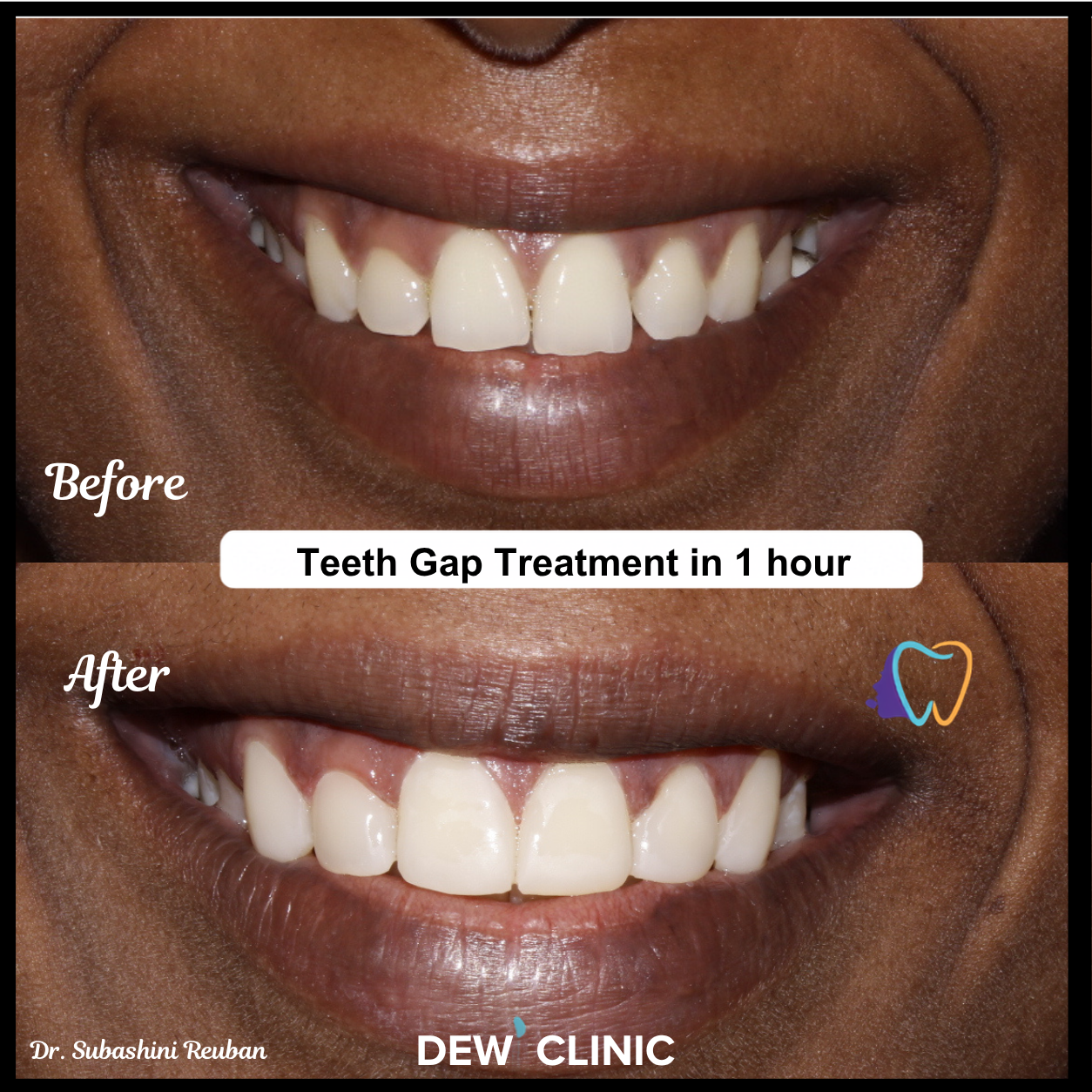 Smile Gap Correction Before After Results