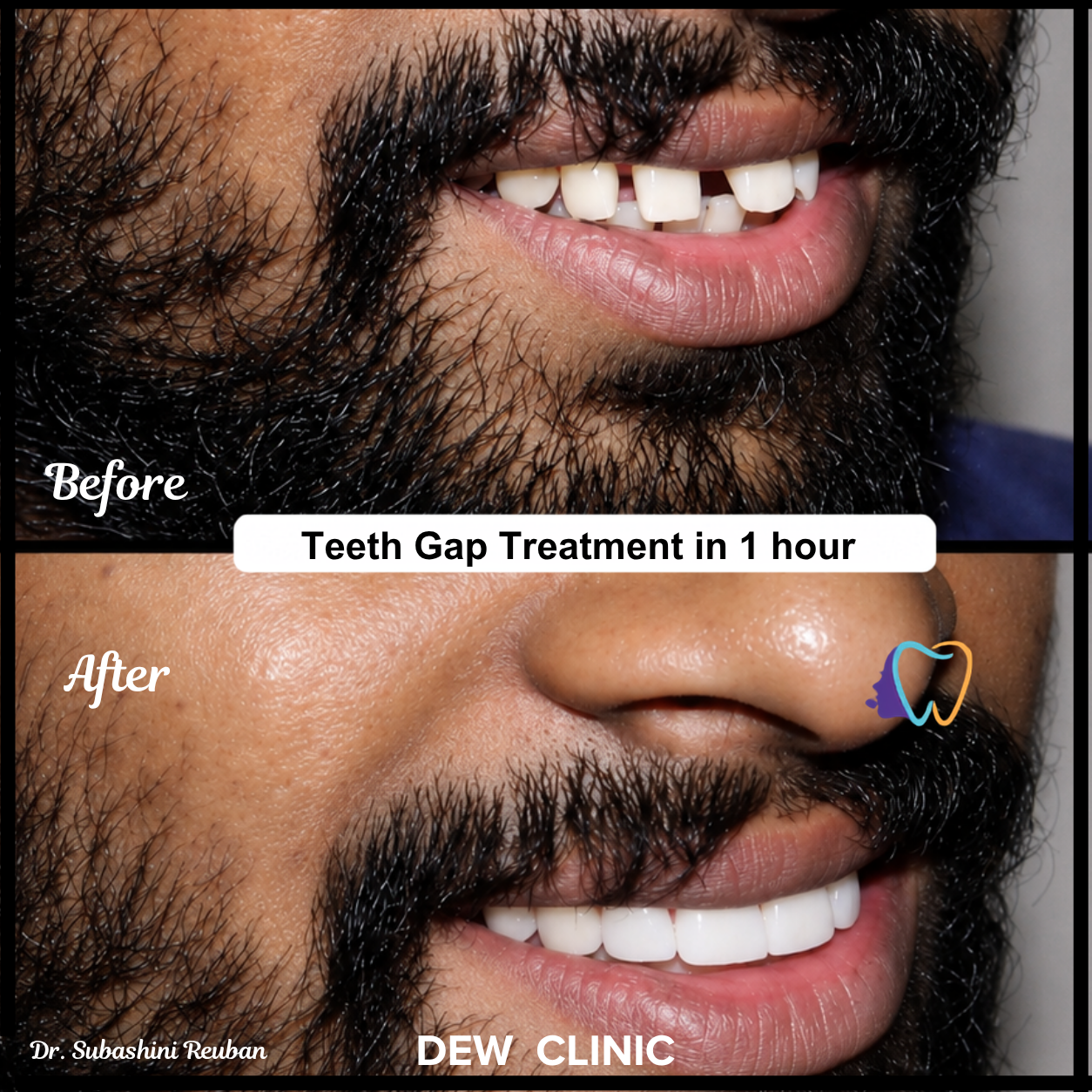 Smile Transformation for Teeth Gap