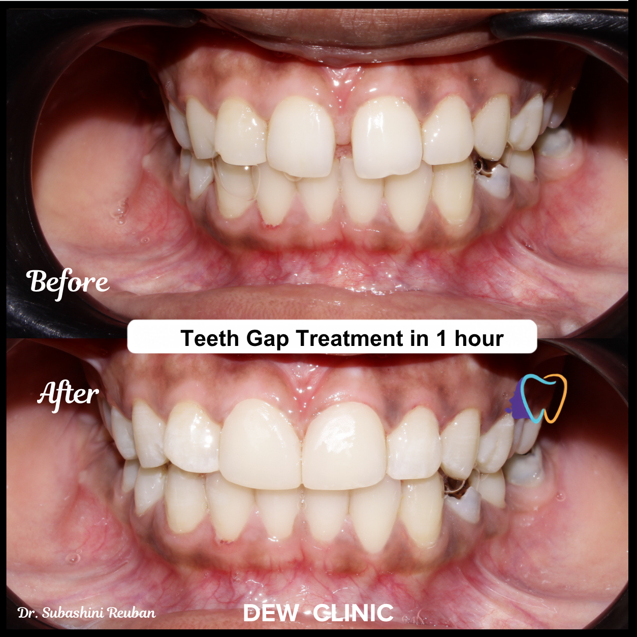 Patient smile before and after professional teeth gap closure treatment