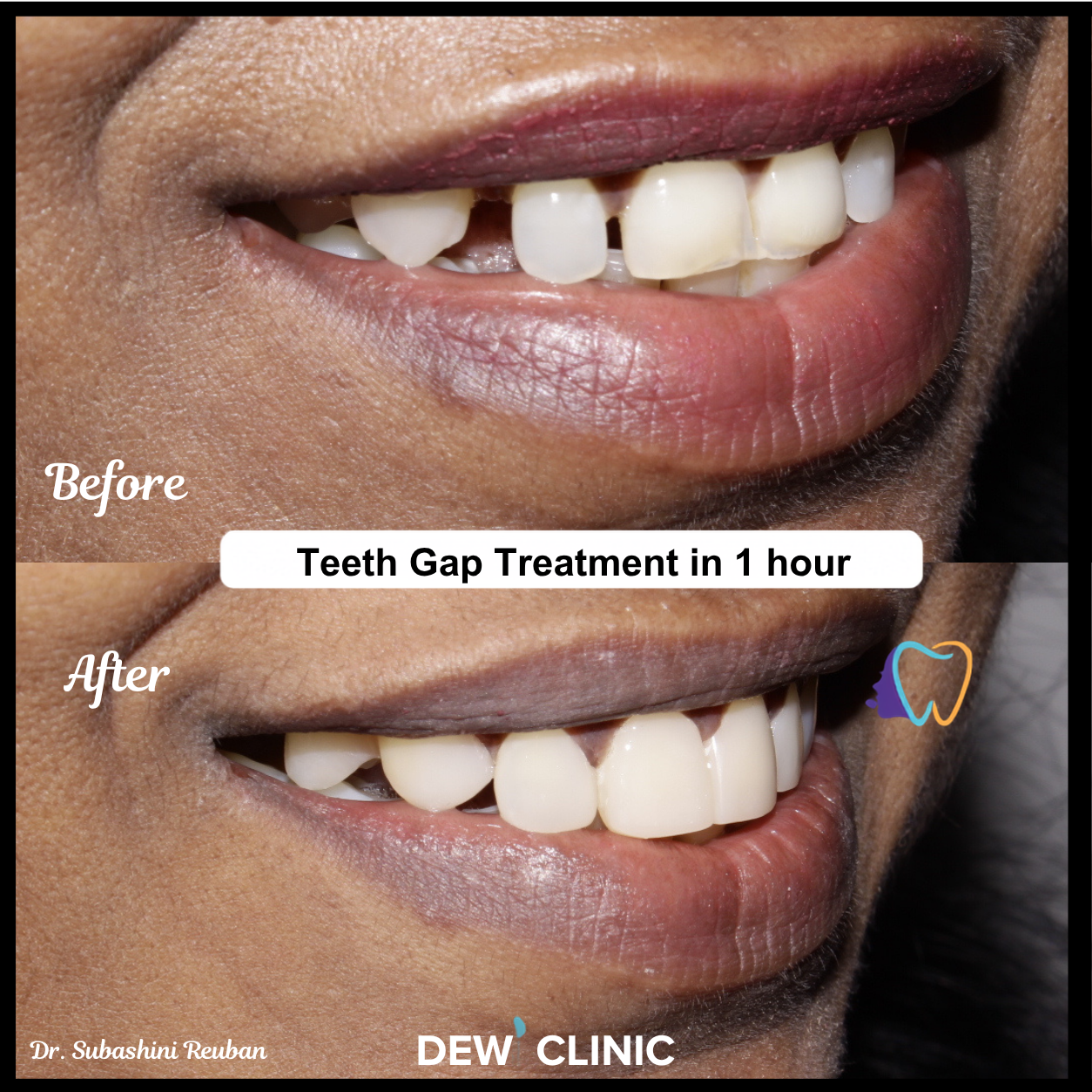 Teeth Gap Before After Smile Improvement