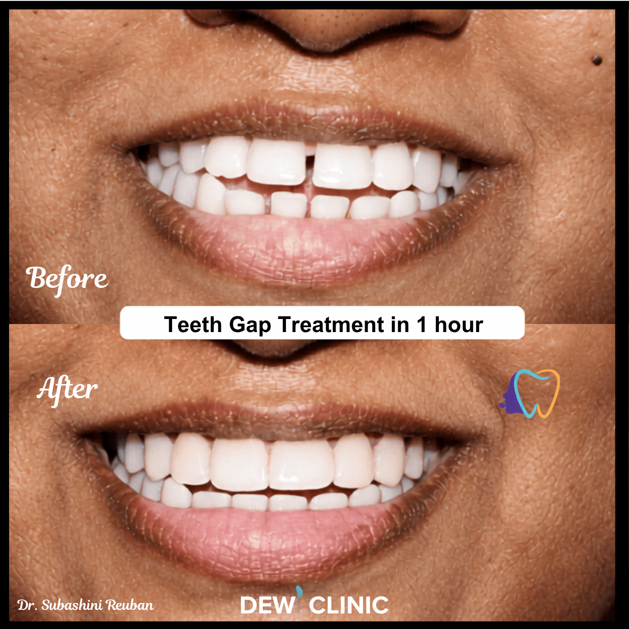 Cosmetic teeth gap closure before and after results by expert dentists in Chennai