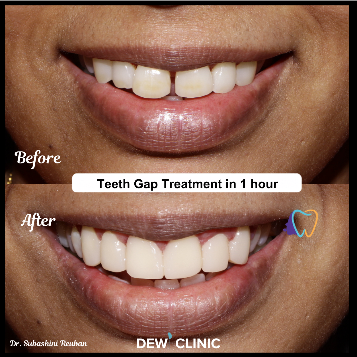 Before and after teeth gap treatment showing a natural smile transformation at Dew Clinic Chennai