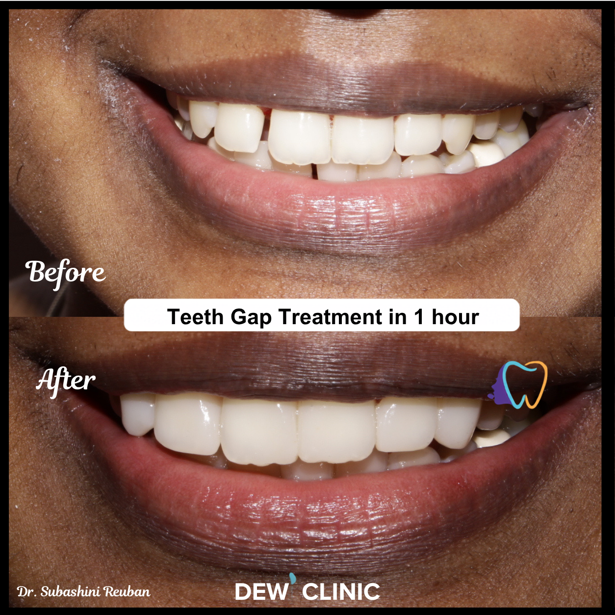 Front teeth gap correction before and after by cosmetic dental specialists