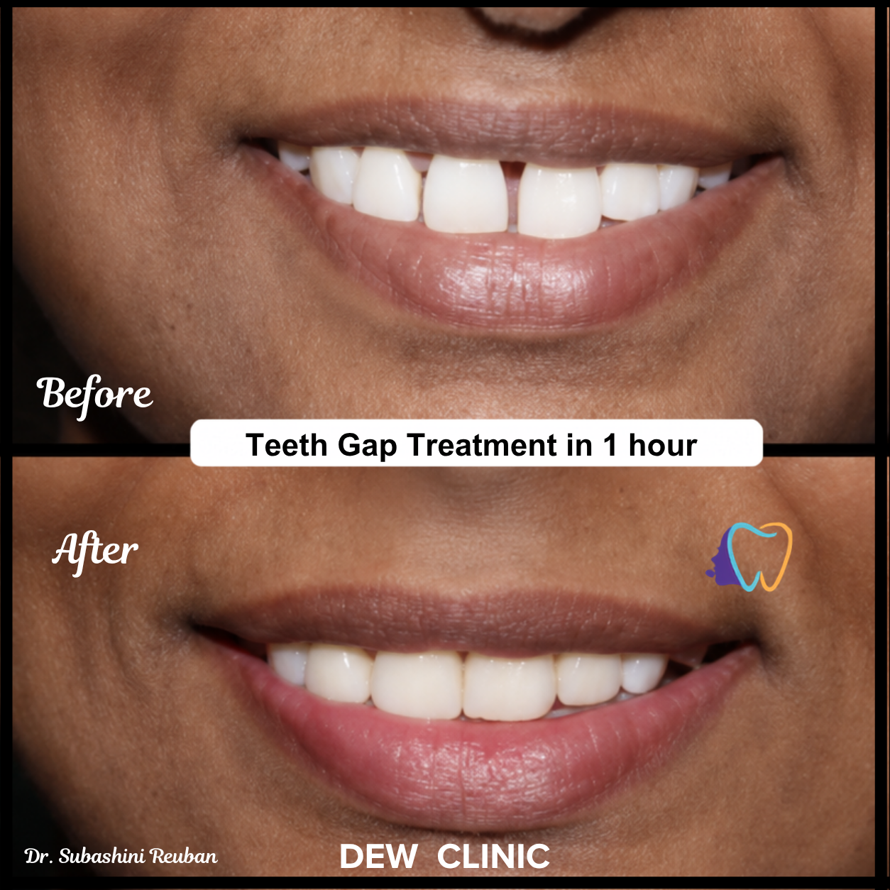 Teeth Gap Treatment in One Hour Chennai