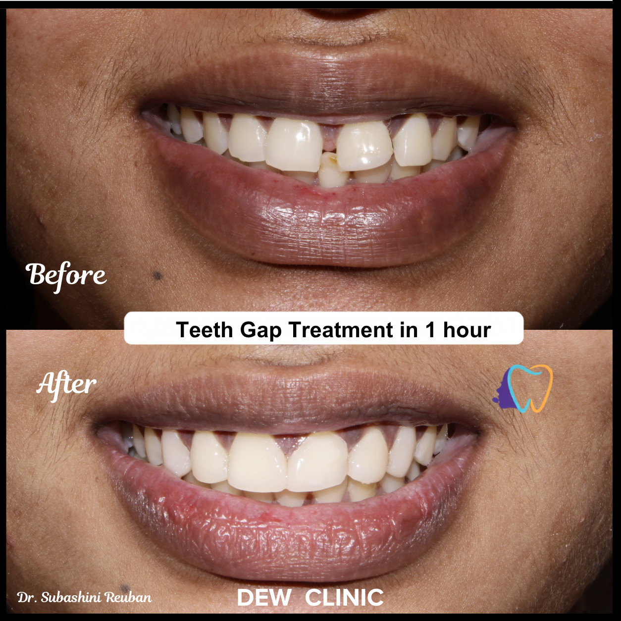 Teeth gap treatment completed in one hour with visible before and after results